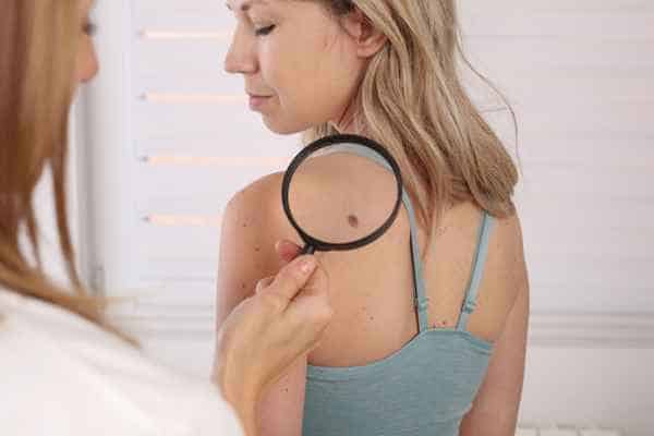 What Are Traditional Skin Lesion Removal Methods Kilmarnock?