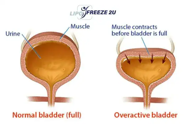 diagram of overactive bladder treatment Kilmarnock