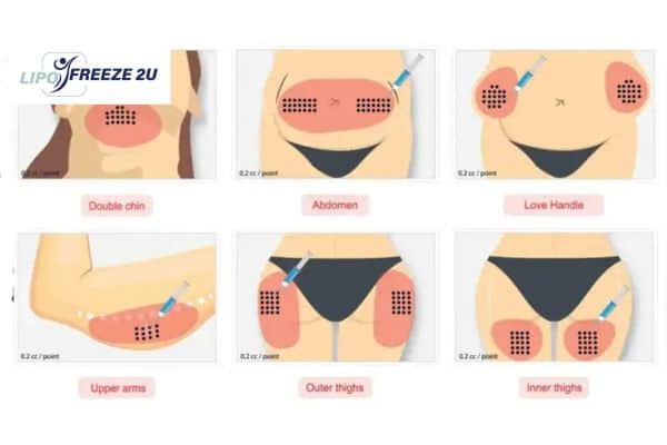Benefits of Choosing Aqualyx for Fat Reduction Kilmarnock