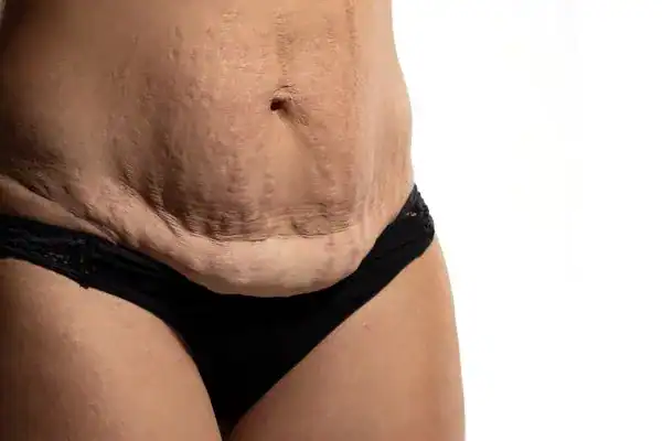 loose skin after weight loss injections Kilmarnock