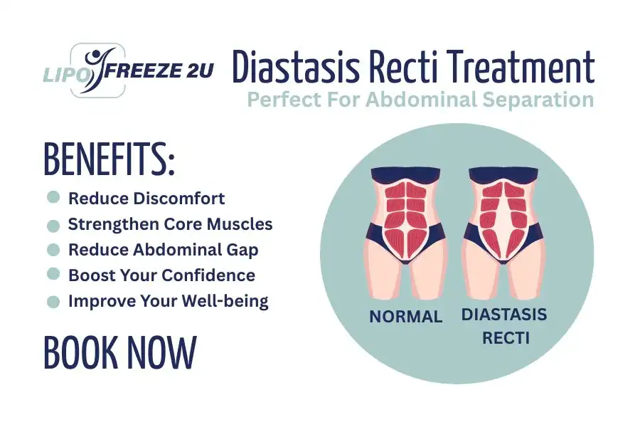 Benefits of body toning treatment Kilmarnock for Diastasis recti