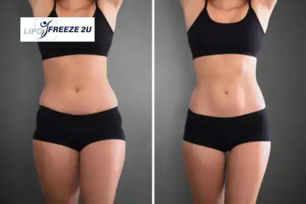 How Can LIPO FREEZE 2U Support Your Post-Pregnancy Body Recovery Kilmarnock?