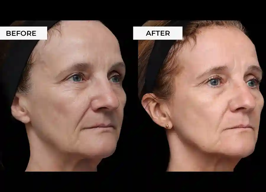 How Many RF Microneedling Sessions Will You Need to See a Difference Kilmarnock?