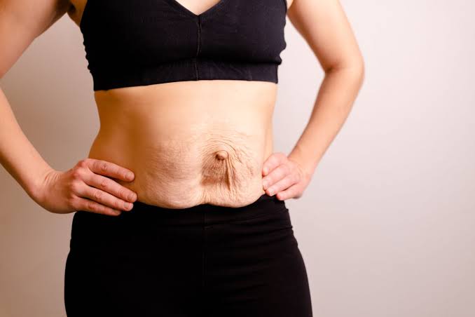 Is Surgery Really the Only Way to Repair Diastasis Recti Kilmarnock?