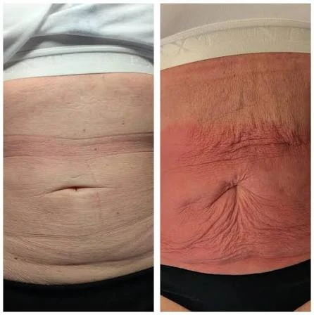 How Does RF Microneedling Improve Crepey, Thin and Uneven Skin Texture Kilmarnock?