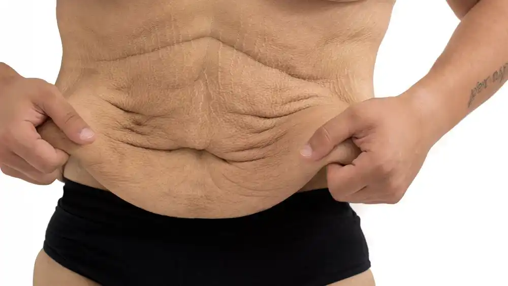 Why Does Weight Loss Medication Leave Some People With Loose or Sagging Skin Kilmarnock?